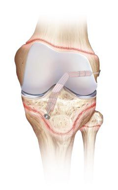 Schema eines Kniegelenks mit angelegter Knieschiene, Hervorhebung der Knochen und Bänder mit farblich gekennzeichneten anatomischen Details.