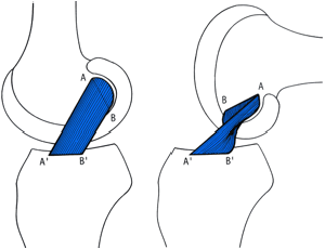 Abbildung eines Kniegelenks, die die unterschiedlichen Positionen der Bänder A und B in zwei Szenarien zeigt.